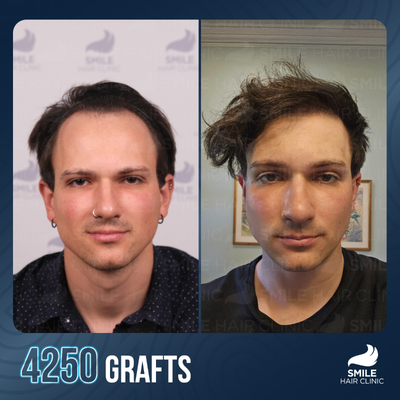 FUE Hair Transplant before and after photo