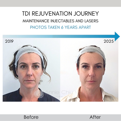 Dermal Fillers before and after photo