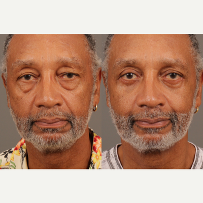 Eyelid Surgery before and after photo