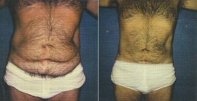 Liposuction before and after photo