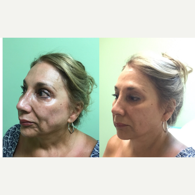 Voluma before and after photo