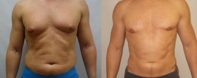 Liposculpture before and after photo
