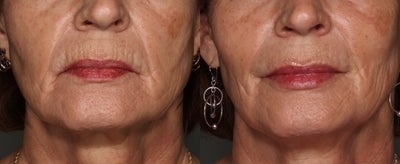 Juvederm before and after photo