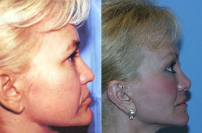 Rhinoplasty before and after photo
