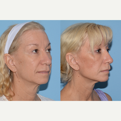 Voluma before and after photo
