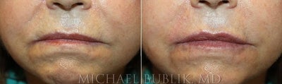 Lip Fillers before and after photo