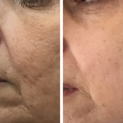 Bellafill before and after photo