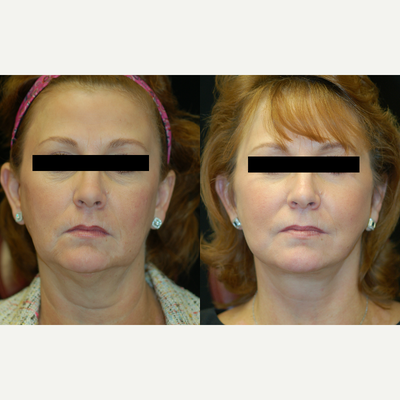 Facelift before and after photo