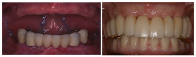 Dental Implants before and after photo