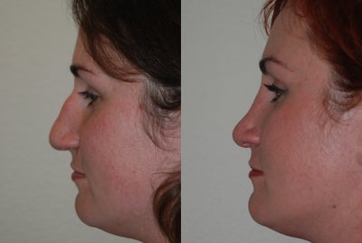Rhinoplasty before and after photo