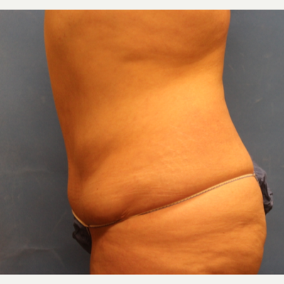 brazilian-butt-lift-tucson-az - Rao Plastic Surgery