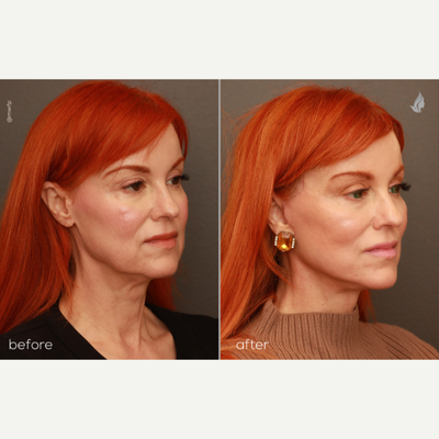 Facelift before and after photo