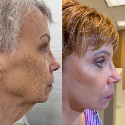 Eyelid Surgery before and after photo