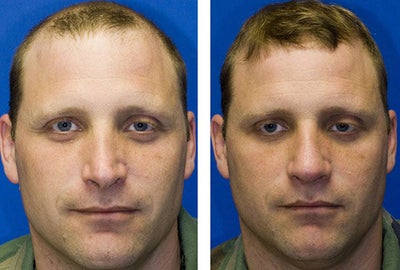 Revision Rhinoplasty before and after photo