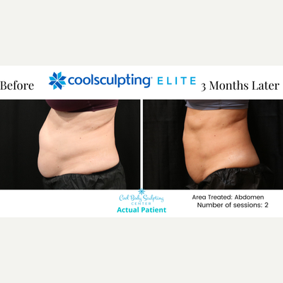 CoolSculpting Elite before and after photo