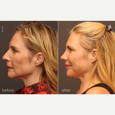 Rhinoplasty before and after photo