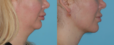 Chin Liposuction before and after photo