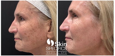 IPL before and after photo
