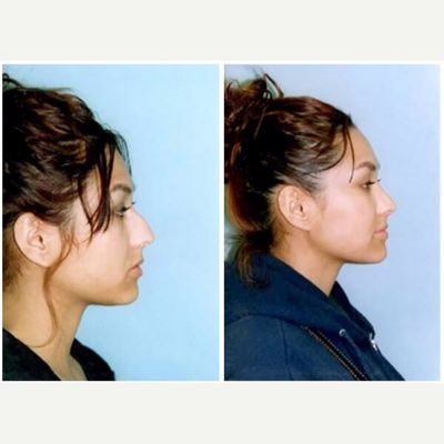 Rhinoplasty before and after photo