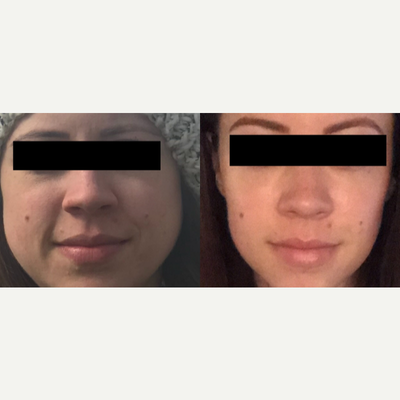 Juvederm before and after photo