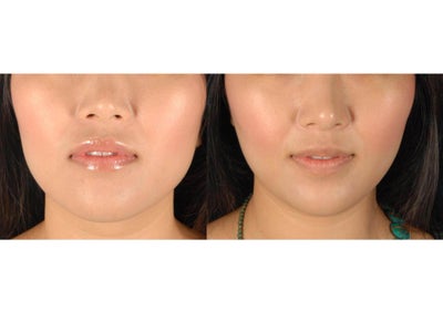 Botox before and after photo
