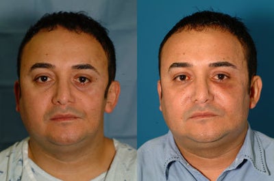 Facial Fat Transfer before and after photo