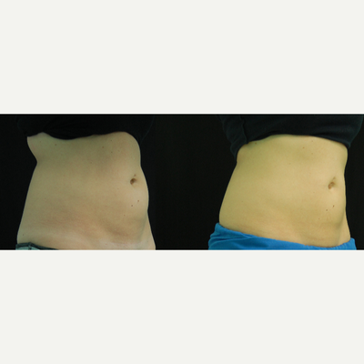 CoolSculpting before and after photo