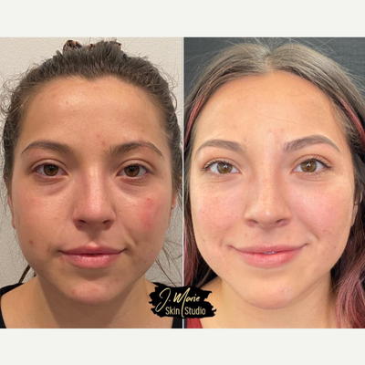 Dermal Fillers before and after photo