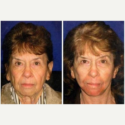 Laser Resurfacing before and after photo