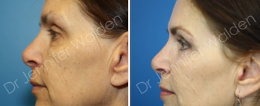 Eyelid Surgery before and after photo