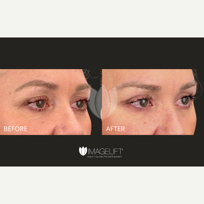 Brow Lift before and after photo