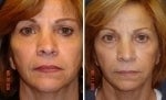 Nonsurgical Nose Job before and after photo