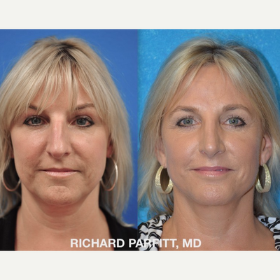 Eyelid Surgery before and after photo