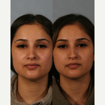 Rhinoplasty before and after photo