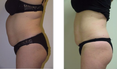 UltraShape before and after photo