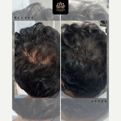 Hair Loss Treatment before and after photo