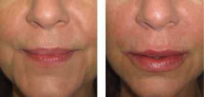 Restylane before and after photo