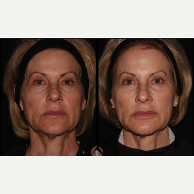Juvederm before and after photo