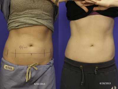 CoolSculpting before and after photo