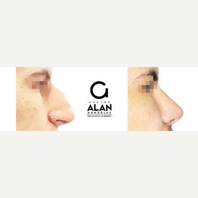 Rhinoplasty before and after photo
