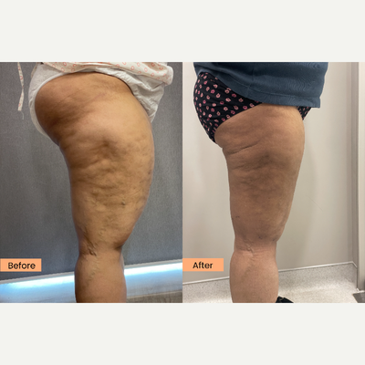 Liposuction before and after photo