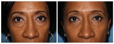 Eyelid Surgery before and after photo