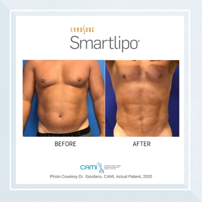 Smart Lipo before and after photo
