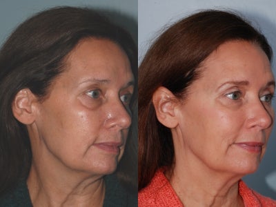 Voluma before and after photo