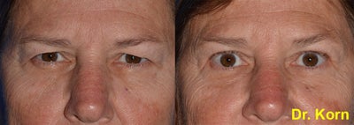 Eyelid Surgery before and after photo