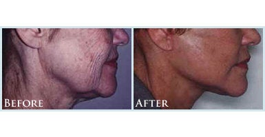 Lower Facelift before and after photo
