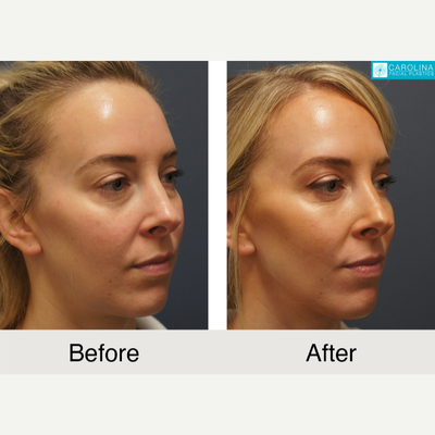 Eyelid Surgery before and after photo