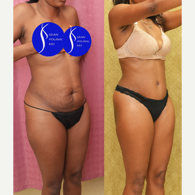 Liposuction before and after photo