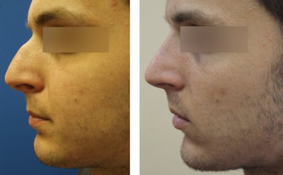 Rhinoplasty before and after photo