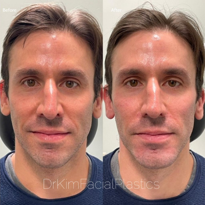 Cheek Fillers before and after photo